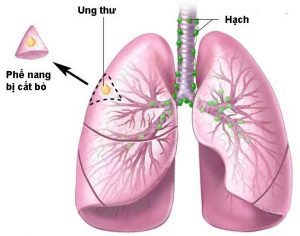 biểu hiện của bệnh ung thư phổi